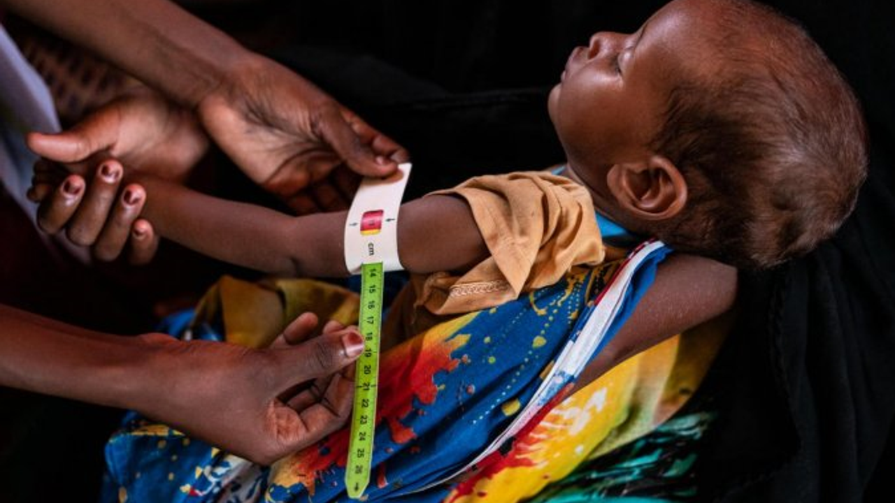 Doğu ve Güney Afrika'da 1,5 milyon çocuk şiddetli zayıflama nedeniyle tedavi göremiyor