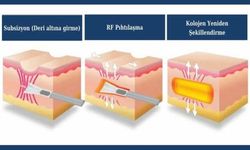 Akne Skarları İçin En İyi Tedaviler: Dermatologların Önerileri