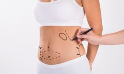 Liposuction ile Hayalinizdeki Görünüme Kavuşun!