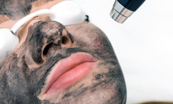 Yağlı ve Akneye Eğilimli Ciltler İçin Medikal Çözümler