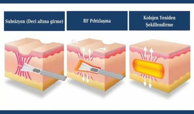 Sivilce Tedavisi ile İz ve Lekeler İçin En Güncel Çözümler!
