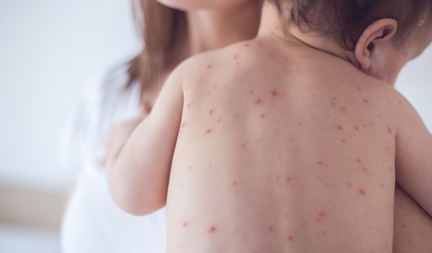 WHO: 2024 yılında dünya genelinde 95.000 kızamık ölümü gerçekleşti